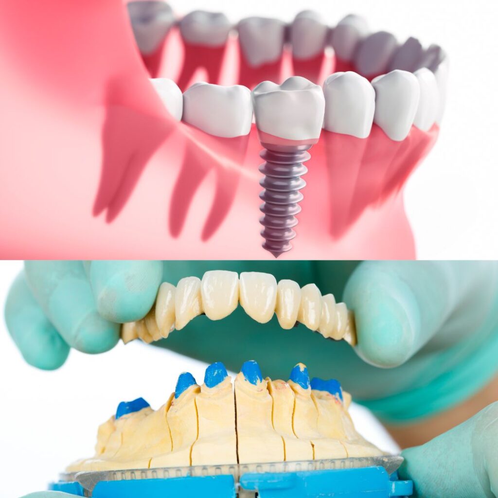 Dental Implants vs. Bridges: Which Is Right for You?