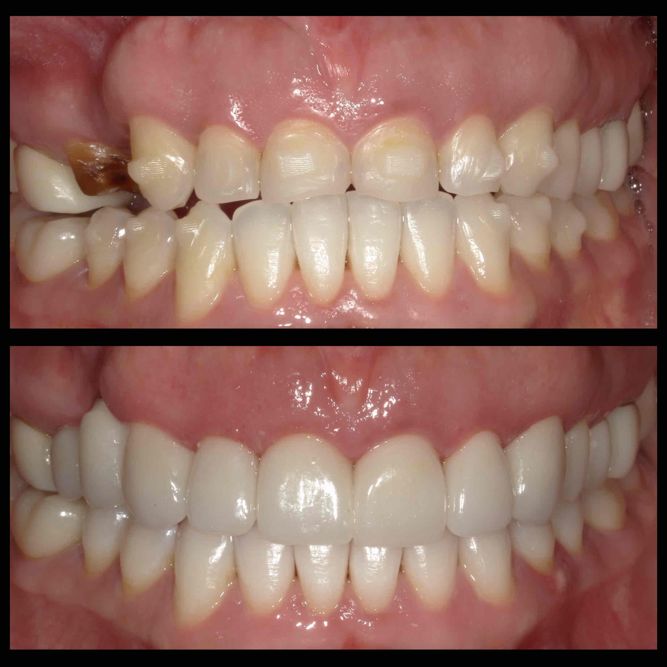 Invisalign Before and after in one photo-optimized